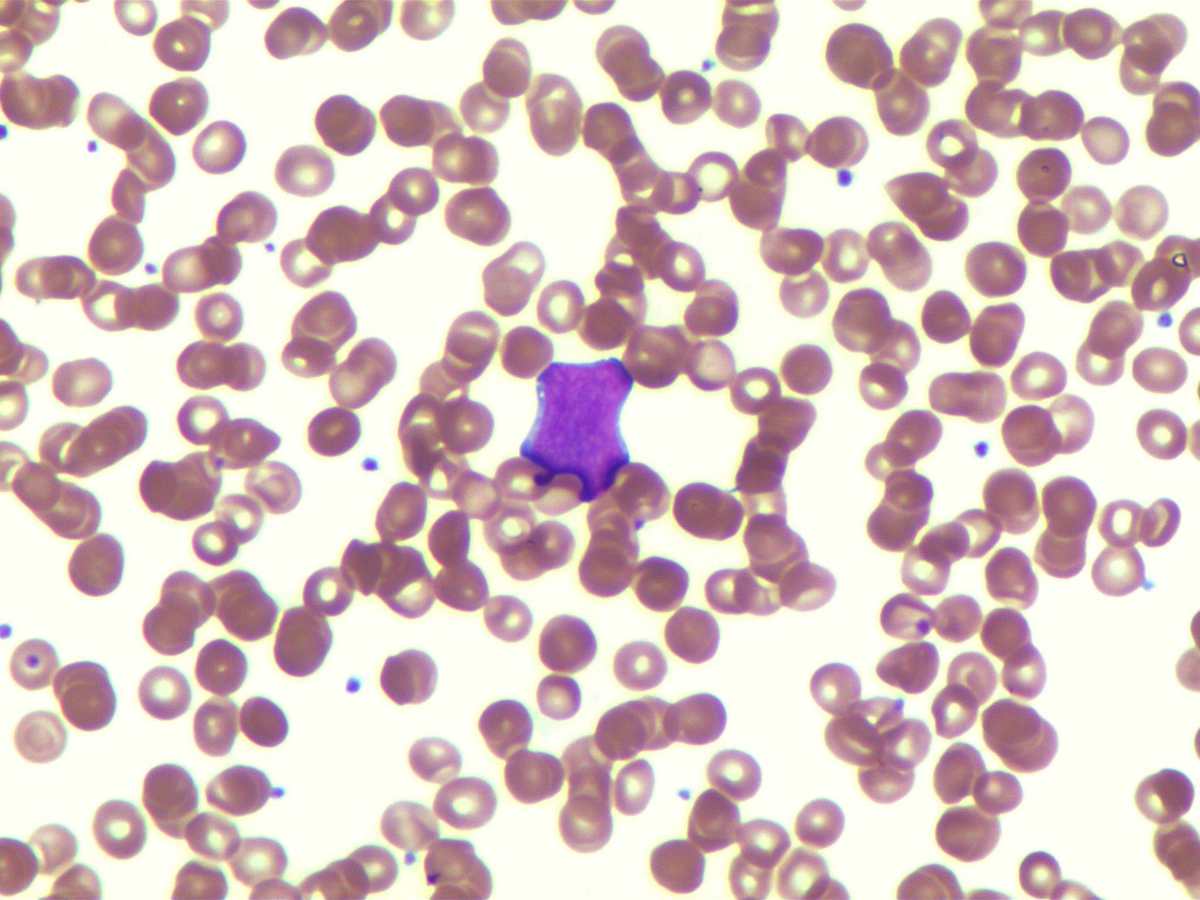 Rare blasts in peripheral blood